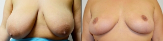 breastreduction2