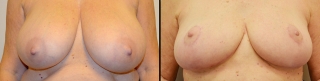 breastreduction1