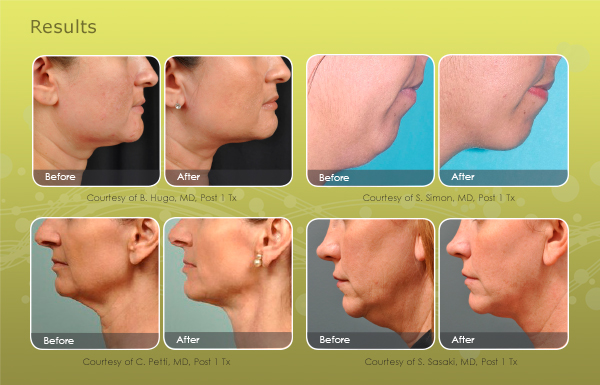 facial-contouring-email-results-600x385